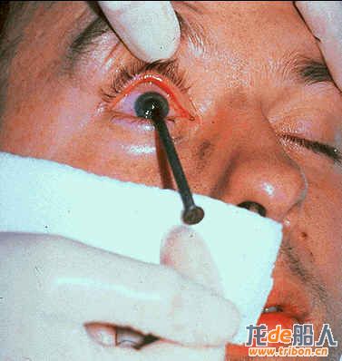 SAFTENG Nail in the eye 01.jpg