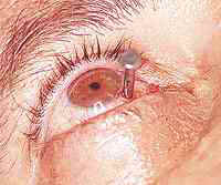 SAFTENG Nail in the eye 03.jpg